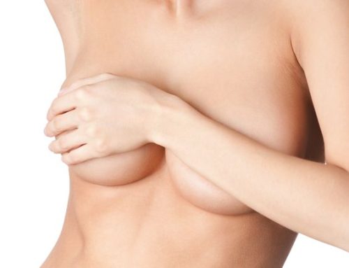 Needling per le smagliature al seno